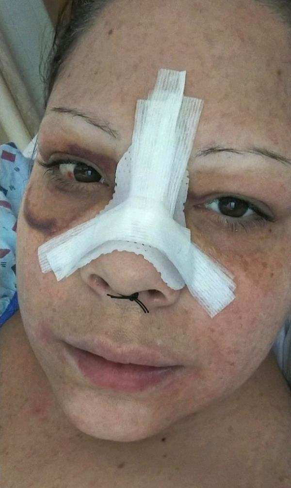 Robles was left with sever facial injuries including a broken nose.