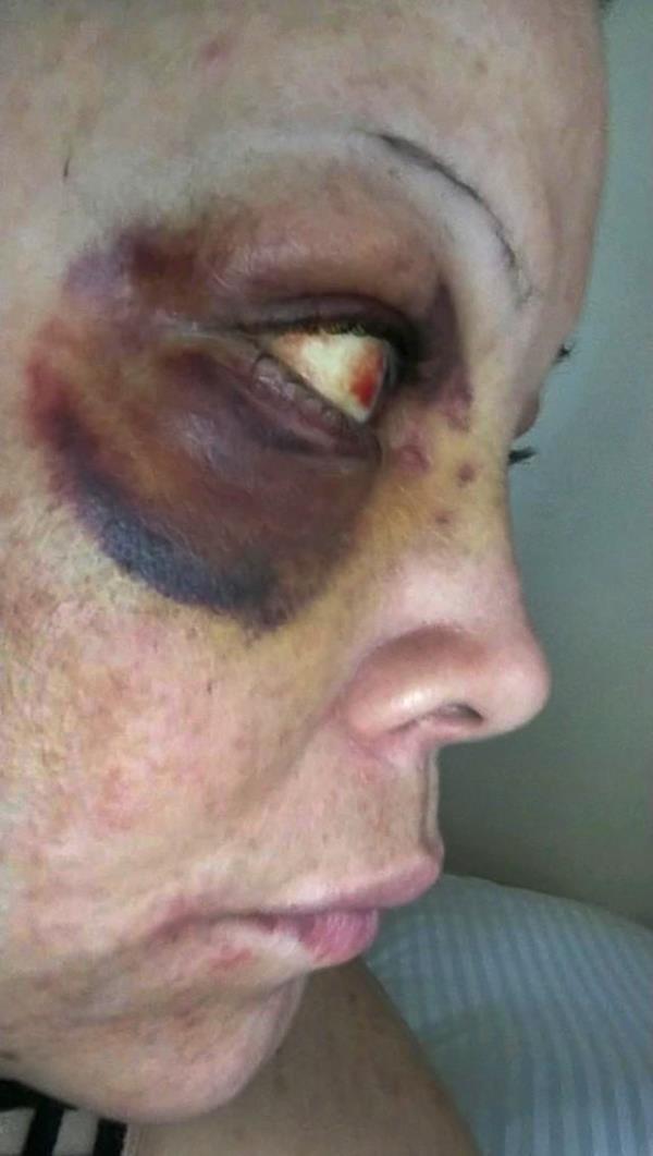 Robles' eye after the subway attack.
